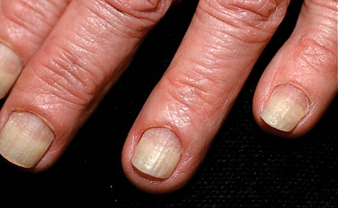 Psoriasis des ongles sur les mains et les pieds: causes, diagnostic et ...